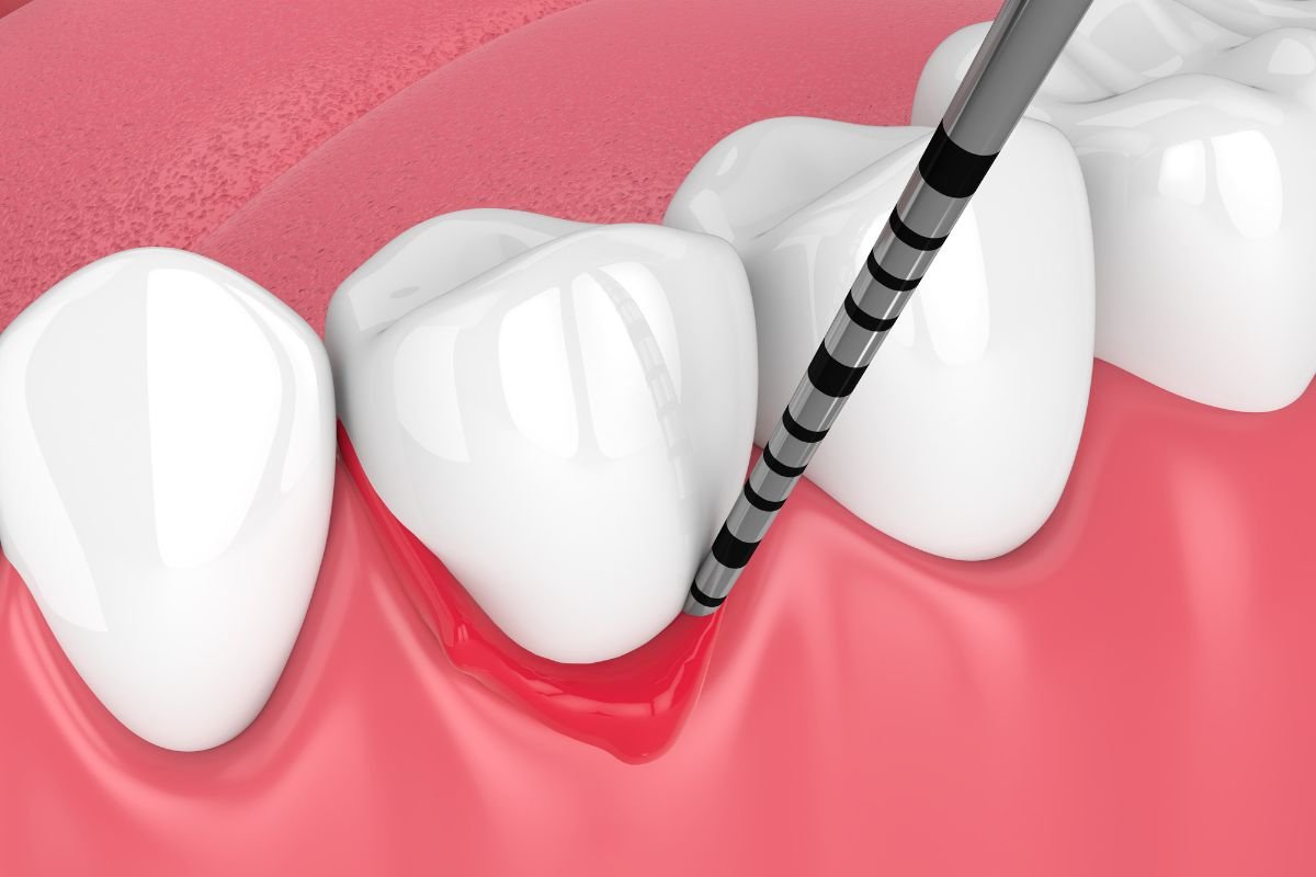 Periodoncia3